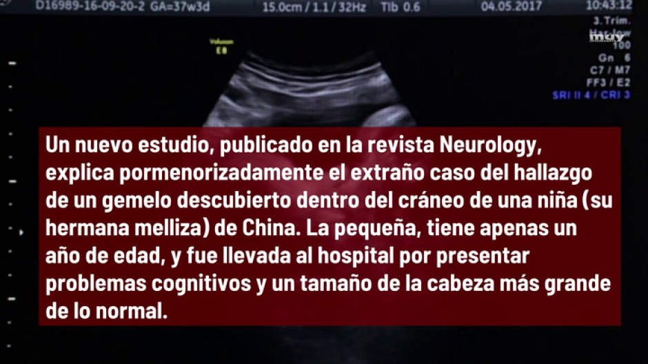 Extraen el feto vivo de un niño del cerebro de su hermana melliza