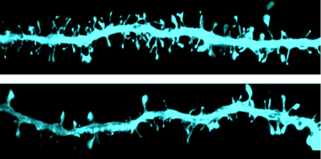 Imagen microscópica de las espinas dendríticas (zona de la neurona donde se produce la sinapsis) donde se observan las diferencias en la morfología de las fibras dopaminérgicas entre un grupo control (imagen superior) y un grupo experimental (imagen inferior). Fuente: Cima universidad de Navarra
