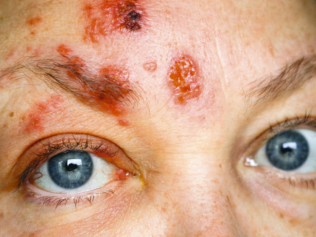 Algunos síntomas del HZ oftálmico son ampollas en la frente, dolor y enrojecimiento ocular, sensibilidad e hinchazón de los párpados.