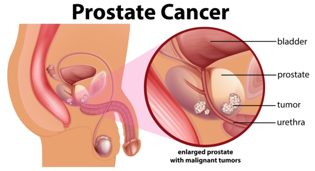 Cáncer de próstata. Localización. Fuente: iStock